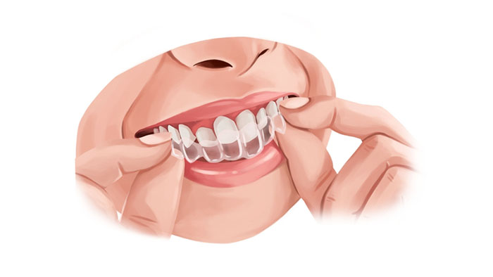 ข้อแนะนำระหว่างการจัดฟันแบบใส Invisalign